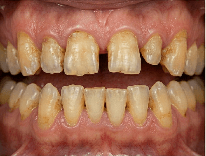 Before treatment