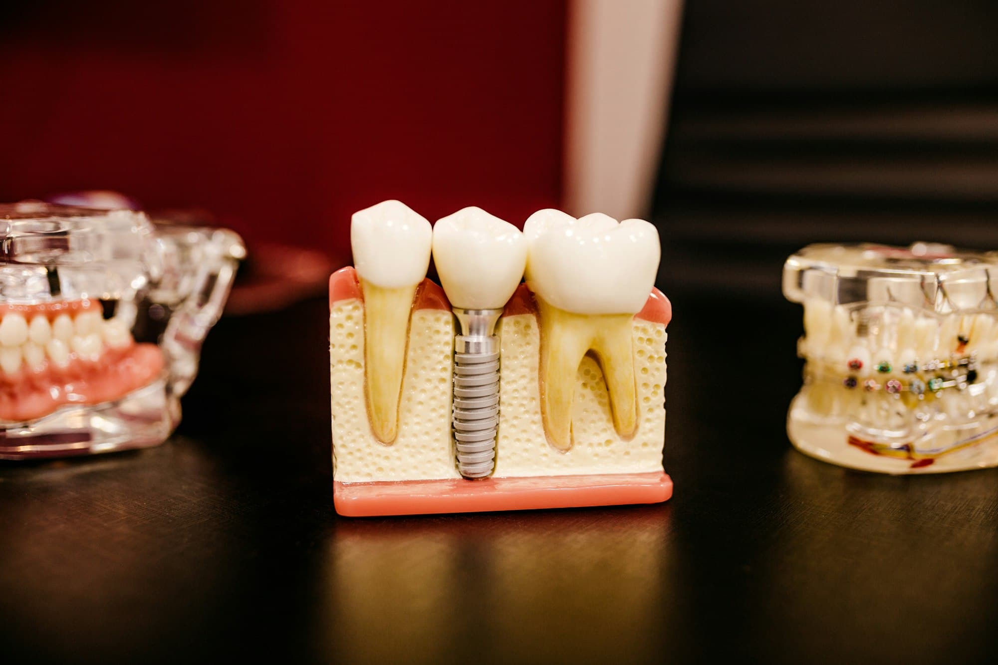 Fixed Crowns & Bridges with Dental Implants